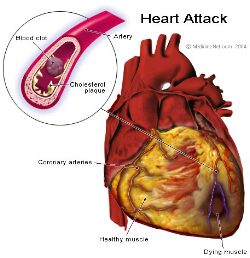 A heart attack is shown with the blood vessel in it.